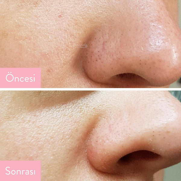Cosrx - BHA Blackhead Power Liquid (Siyah Nokta Önleyici Tonik 100ml)