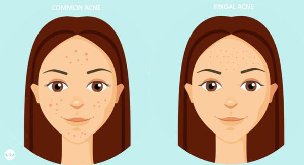 Fungal Akne Problemine Özel Kore Cilt Bakımı