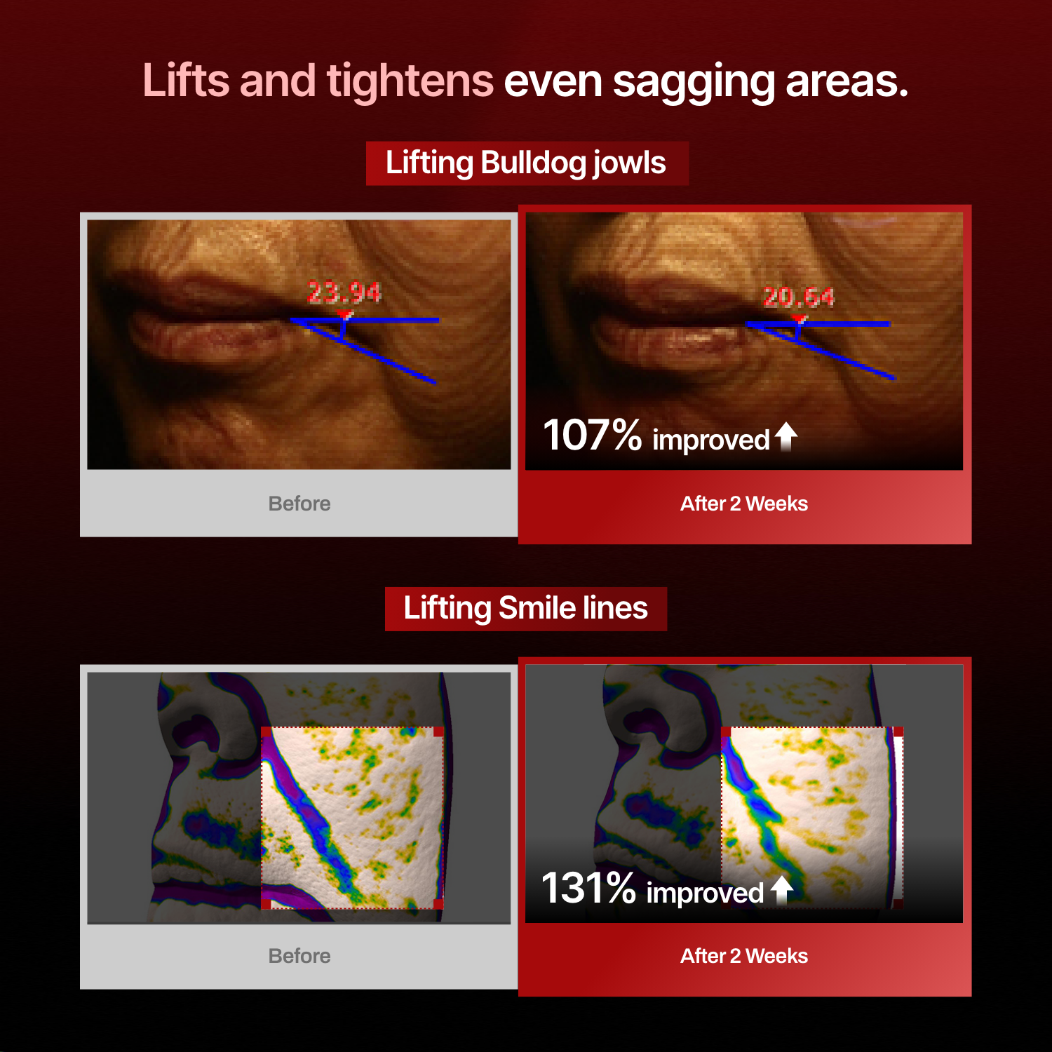 lifts and tightens even sagging areas