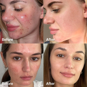 Medicube - Red Succinc Acid Serum (Akne ve Leke Karşıtı Parlatıcı Süksinik Asit Serumu) 30ml