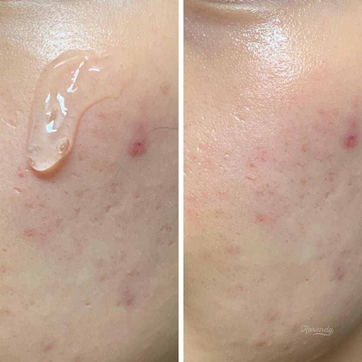 Rovectin - Clean LHA Blemish Ampoule 15ml Ampül Korendy Türkiye Turkey Kore Kozmetik Kbeauty Cilt Bakım 