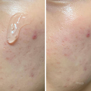 Rovectin - Clean LHA Blemish Ampoule 15ml Ampül Korendy Türkiye Turkey Kore Kozmetik Kbeauty Cilt Bakım 