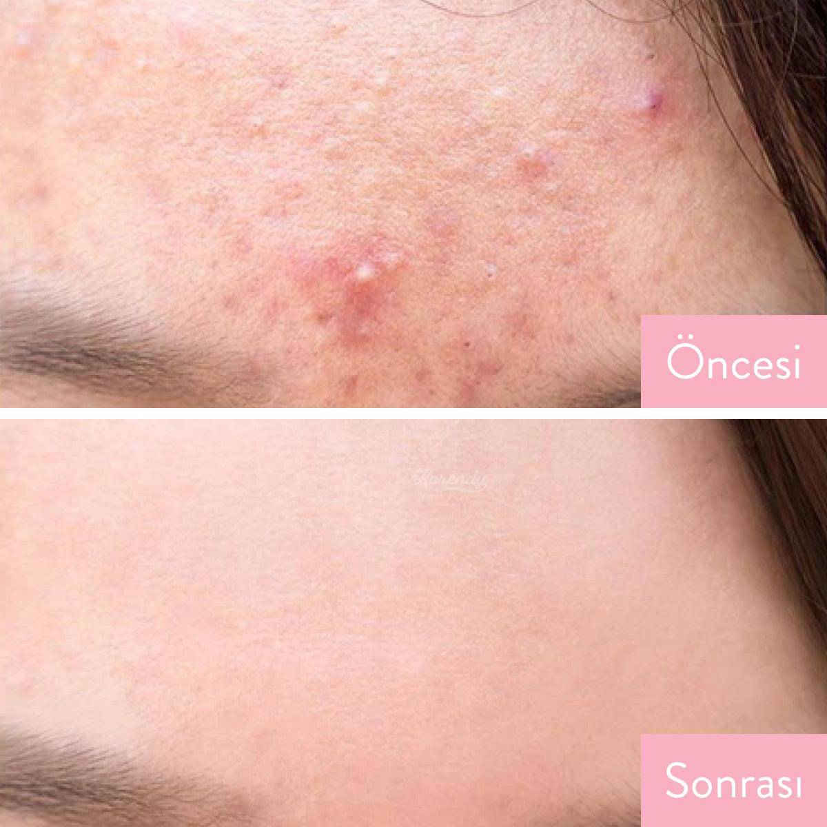 Some By Mi - AHA BHA PHA 30 Days Miracle Cleansing Bar - 106g Temizleyici (Su Bazlı) Korendy Türkiye Turkey Kore Kozmetik Kbeauty Cilt Bakım 