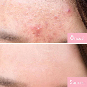 Some By Mi - AHA BHA PHA 30 Days Miracle Cleansing Bar - 106g Temizleyici (Su Bazlı) Korendy Türkiye Turkey Kore Kozmetik Kbeauty Cilt Bakım 