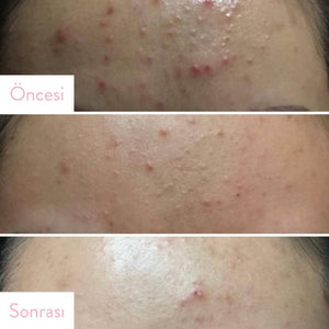 Some By Mi - AHA BHA PHA 30 Days Miracle Serum 50ml Serum Korendy Türkiye Turkey Kore Kozmetik Kbeauty Cilt Bakım 