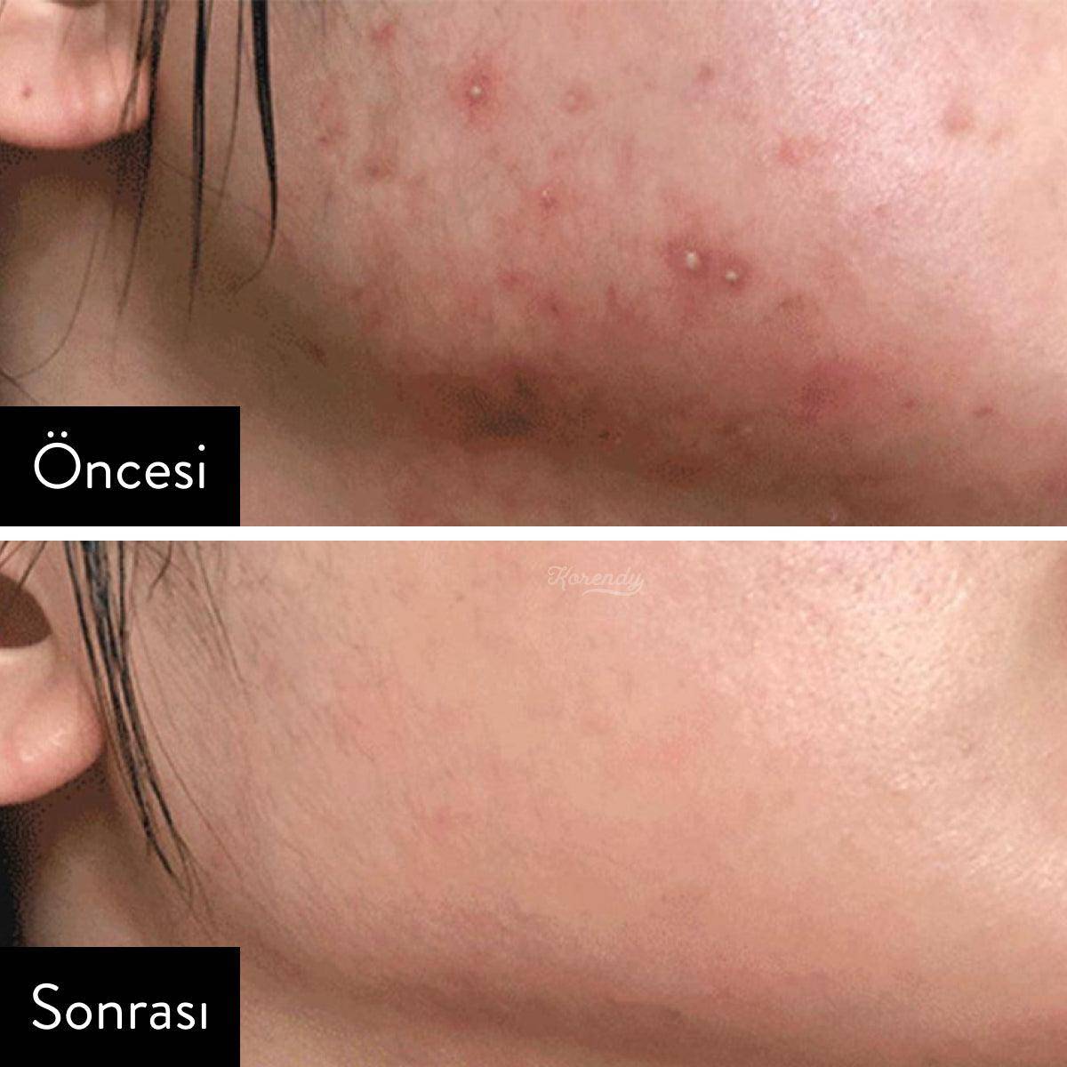 Some By Mi - AHA BHA PHA 30 Days Miracle Toner 150ml (Kimyasal Peeling) Peeling Korendy Türkiye Turkey Kore Kozmetik Kbeauty Cilt Bakım 