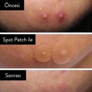 Some By Mi - Clear Spot Patch 18'li Arac Korendy Türkiye Turkey Kore Kozmetik Kbeauty Cilt Bakım 